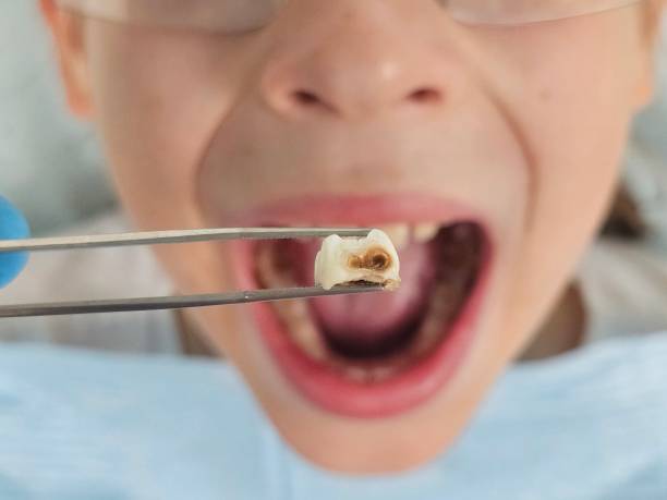Best Emergency Dental Extractions in Marlton, NJ